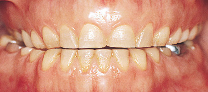 Obraba zob pri bruksizmu