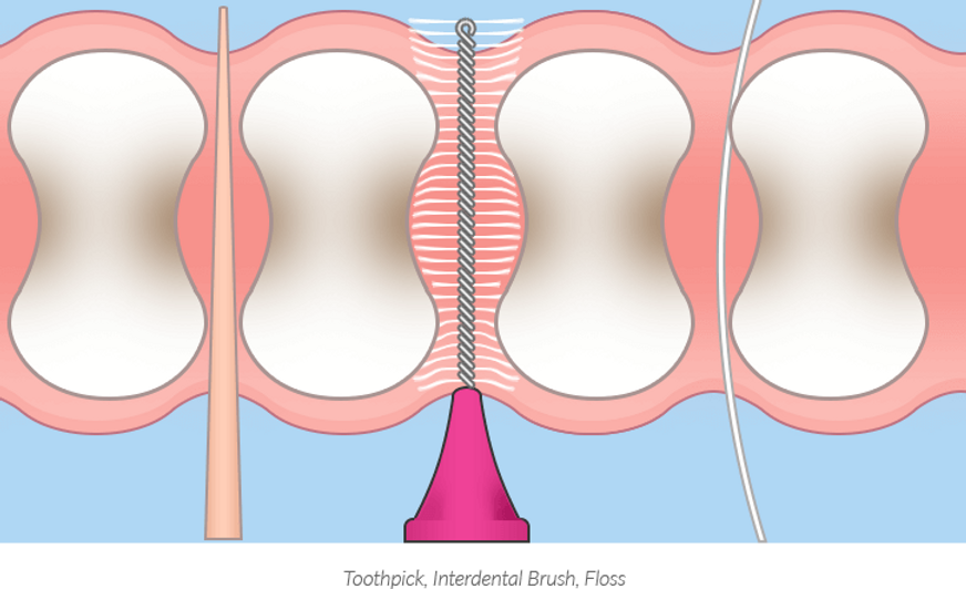 Interdentalne krtačke