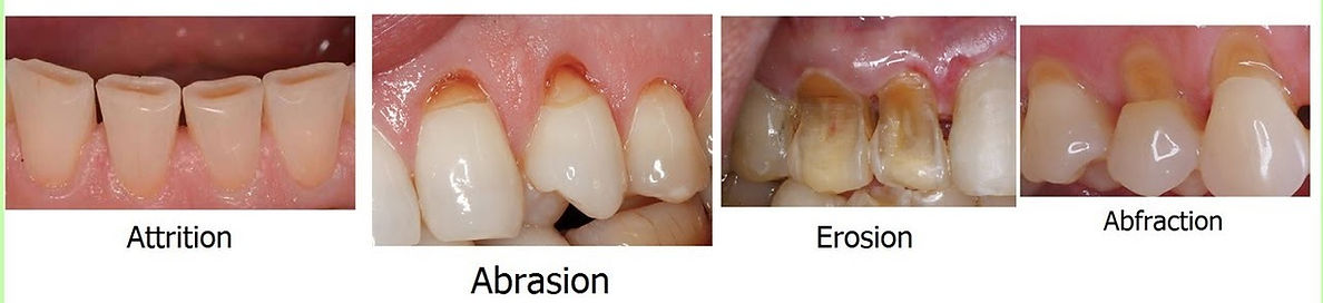 Obraba trdih zobnih tkiv