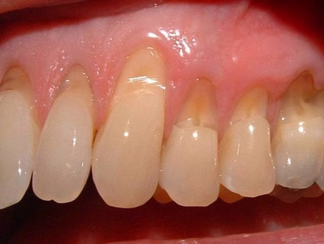 Obrabe trdnih zobnih tkiv