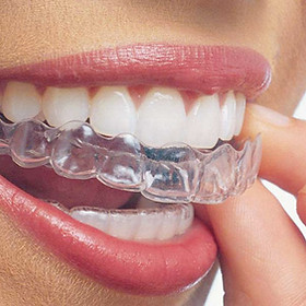 Invisalign aparati